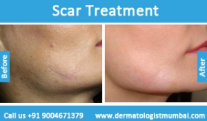 scars removal treatment before and after result