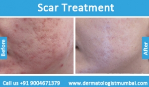 scars removal treatment before and after result