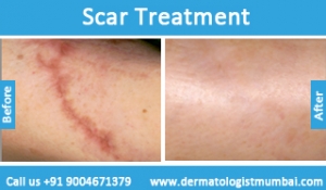 scars removal treatment before and after result mumbai