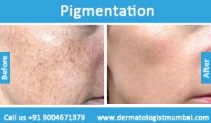 skin pigmentation treatment before after photos in mumbai