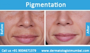 skin pigmentation treatment before after photos in mumbai