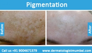 skin pigmentation treatment before after photos