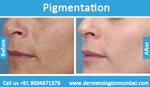 skin pigmentation treatment before and after photos in mumbai