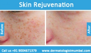 skin rejuvenation treatment before after photos in mumbai