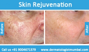 skin rejuvenation treatment before after photos in mumbai