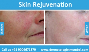 skin rejuvenation treatment before and after photos in mumbai
