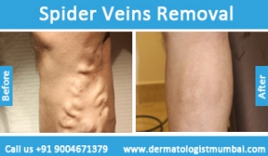 spider veins removal treatment before after photos