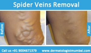 spider veins removal treatment before and after photos