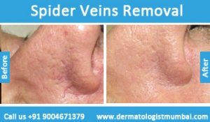 spider veins removal treatment in before and after photos