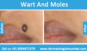 warts and moles removal treatment before after photos