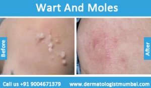 warts and moles removal treatment before after result