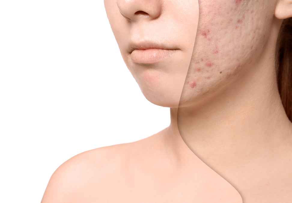 Acne Treatment in Mumbai (Laser Treatment for Acne Scar & Face Pimple)