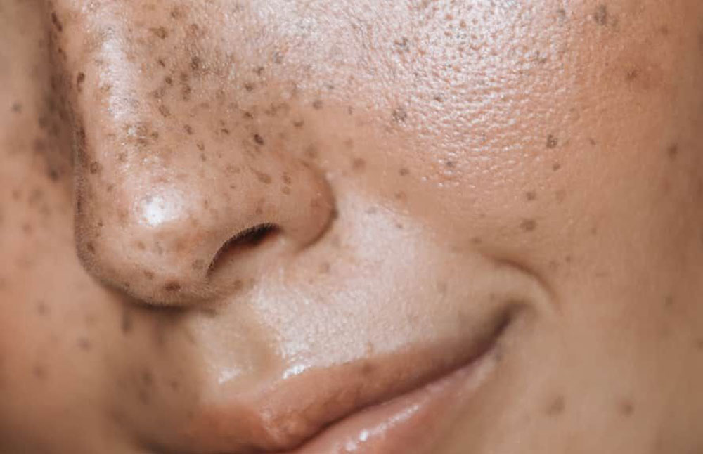 Dark Skin Pigmentation, Hyperpigmentation Treatment in Mumbai, India 